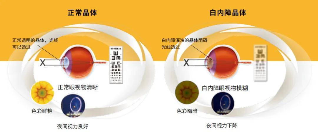 玻璃體混濁最新特效藥，突破與創(chuàng)新的治療策略